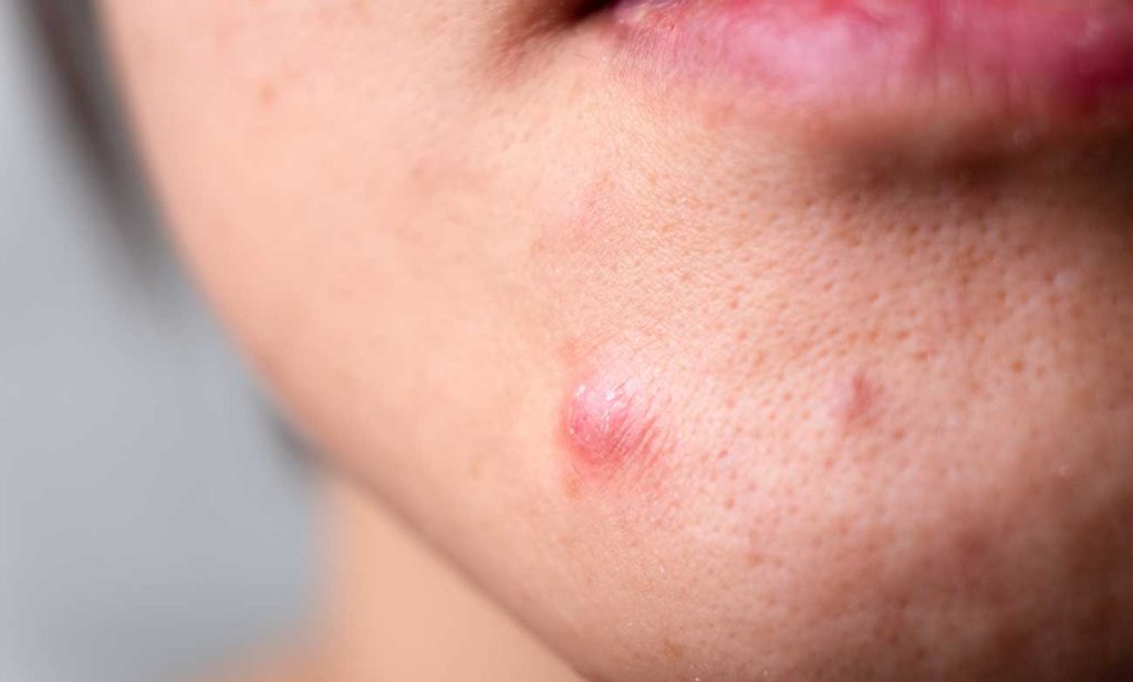 Using laser to cure acne? The Ryder Clinic