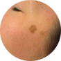age spot removal